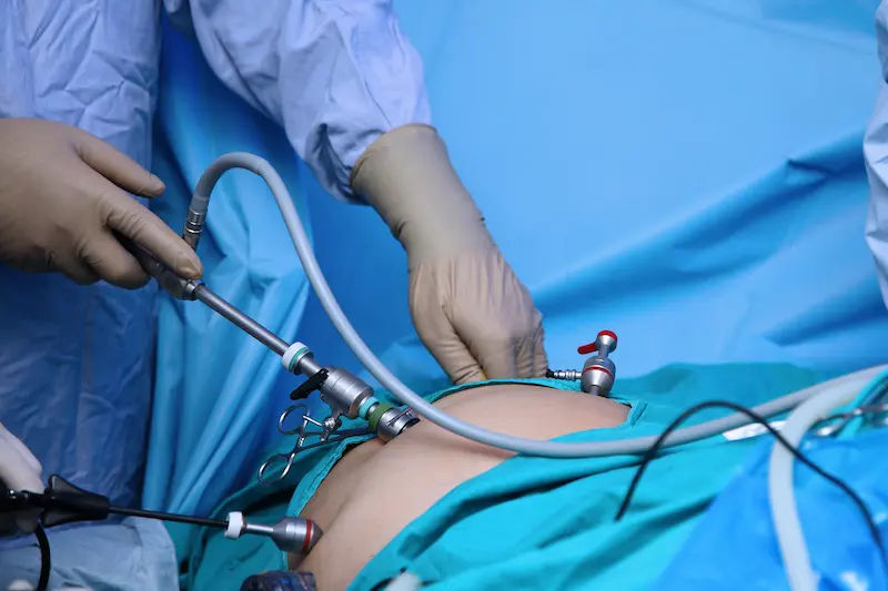 Minimal Access Laparoscopic Surgery A Complete Guide